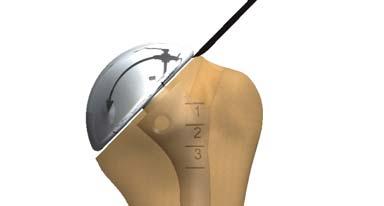 ANATOMICAL IMPLANT REMOVAL 1 Humeral head removal: