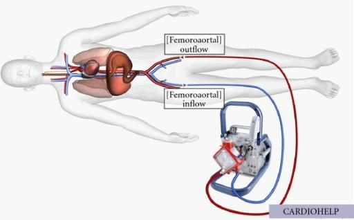 Veno-Arterial ECMO Peripheral Cannulation