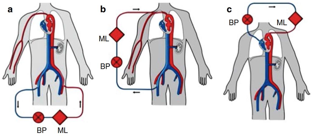 Veno-arterial ECMO Possible circuits: femoral-femoral femoral-axillary central cannulation BP - blood pump ML - membrane