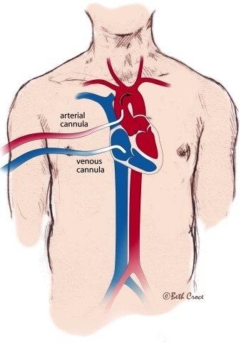 Veno-Arterial ECMO Central Cannulation