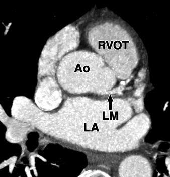 left main coronary artery, LV = left ventricle, PDA = posterior descending artery, RA = right atrium, RCA = right coronary artery, RV