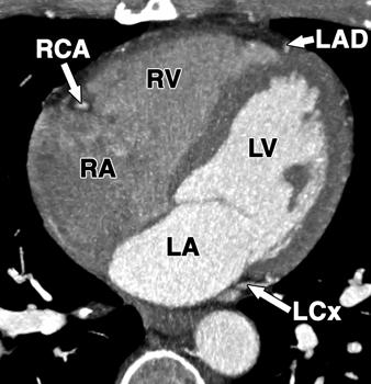 coronary artery. (C) Axial 5-mm MIP image shows course of right coronary artery within anterior atrioventricular groove.