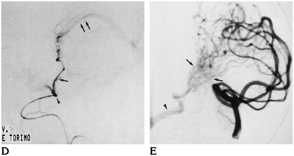 B, Angiogram of the left internal carotid artery, arterial phase, lateral view, shows two pathologic blushes: one in the basal ganglia and the second in the parietal region.