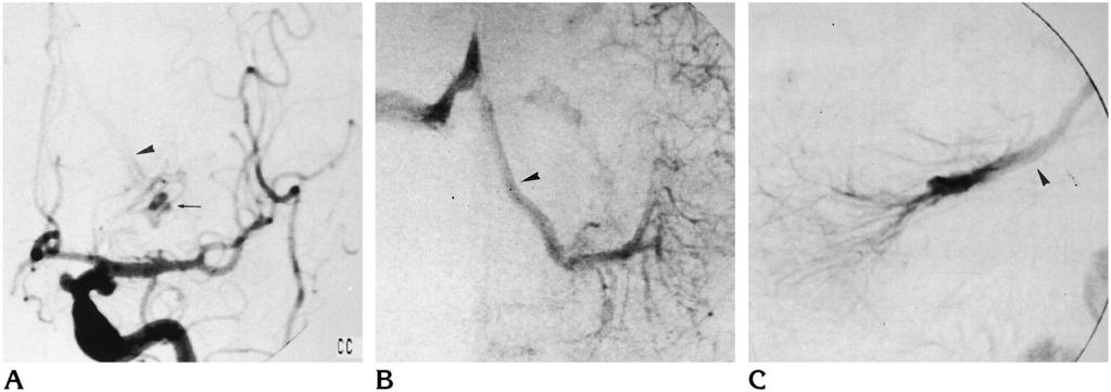 AJNR: 18, April 1997 VASCULAR MALFORMATIONS 781 Fig 2. A 35-year-old woman 3 years after sudden onset of diplopia and hemiparesis.