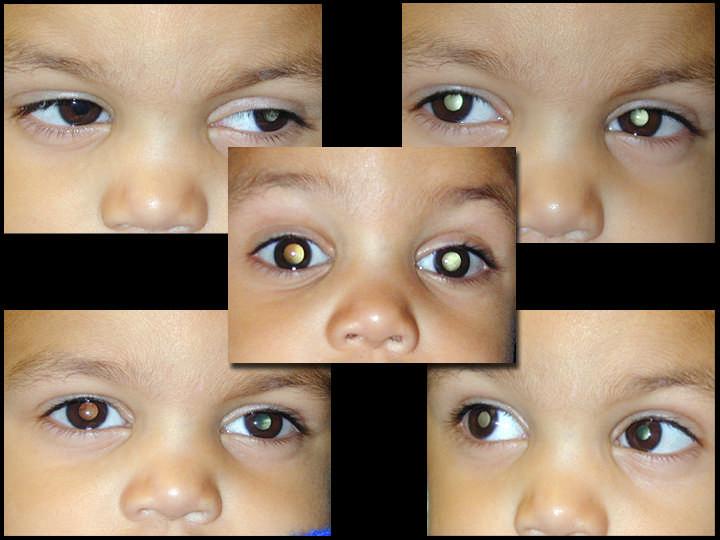 A 5 Red Eye A 6 White Eye (Leukocoria) Carlos Rodriguez-Galindo, MD, St.