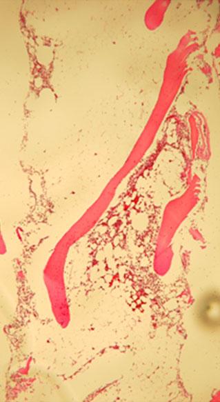 132 Gak-Won Yun, et al. Fig. 2. Representative bone marrow biopsy findings (hematoxylin and eosin [H&E] stain, 100). (A) Marked hypocellularity with even cellular distribution (from UPN 1).