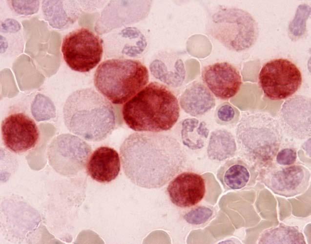 CMML: definition Monocytes >1 x10 9 /L >10% of WBC Dysplasia