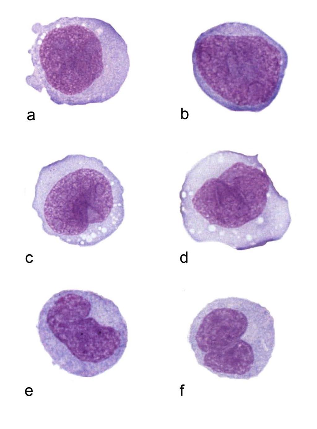 Monoblasts Promonocytes Monoblasts Large cells with abundant cytoplasm minimally vacuolated round nuclei with fine chromatin and nucleoli Promonocytes Irregular or folded nuclei, small indistinct