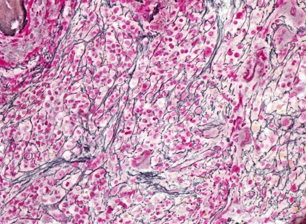 Fibrosis in RARS-T 5 of 32 cases (16%)