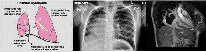 PAH with abnormal pulmonary vasculature Scimitar syndrome (1-3 in every 100,000 live births)