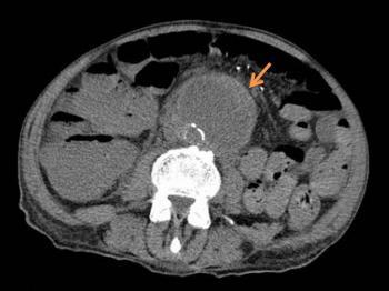 Pre-contrast axial image shows a large outpouching of the distal abdominal aorta, despite