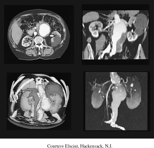 The images below demonstrate a large Abdominal Aortic Aneurism or AAA.