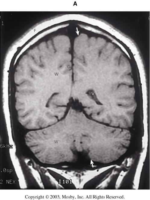 Coronal images through a normal brain.