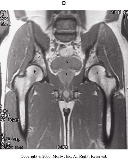 This coronal pelvis shows the prostate (P), which is enlarged and bladder (B).
