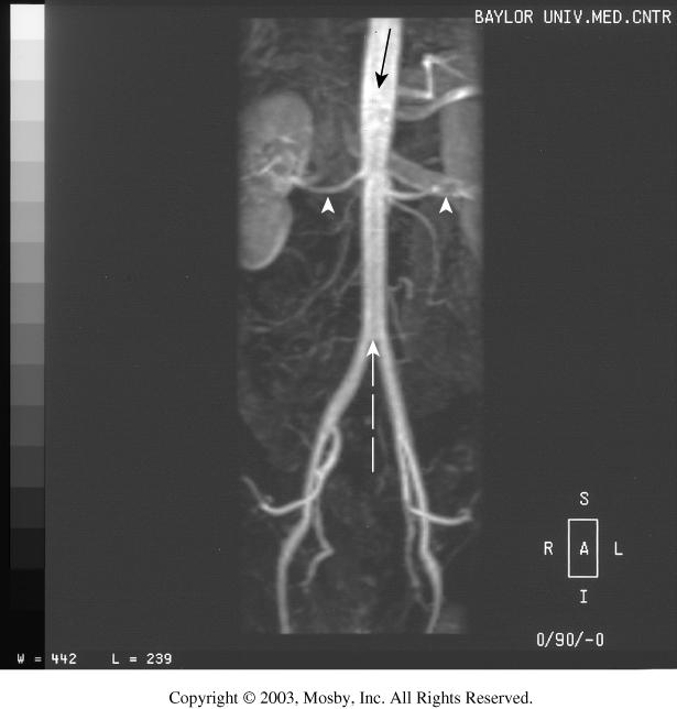Contrast-enhanced MRA of the abdominal aorta (arrow), showing the renal