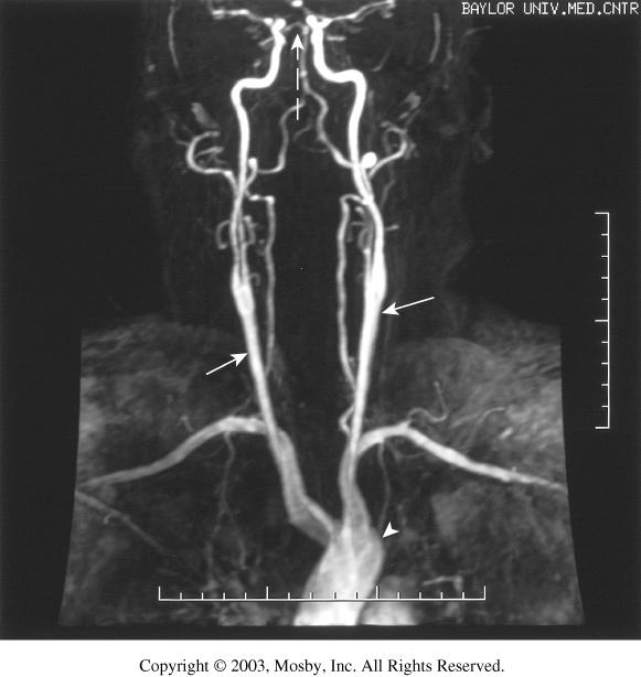 Contrast-enhanced MRA showing the carotid arteries (arrows) from the
