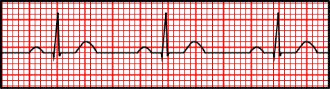 Interpreting ECGs An ECG is printed on paper covered with a grid of squares.
