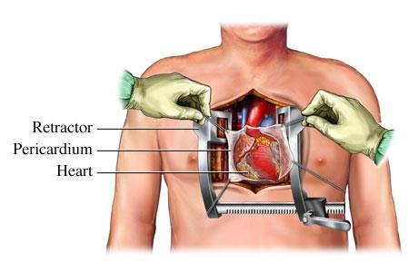 Disorders of the Circulatory System 1. MVP - mitral valve prolapse, valve shifts out of place; this creates a clicking sound at the end of a contraction. 2.
