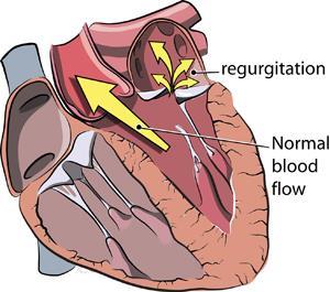 3. Mitral or aortic regurgitation: Regurgitation (backward flow) of blood can occur with mitral valve prolapse or mitral valve or aortic stenosis.