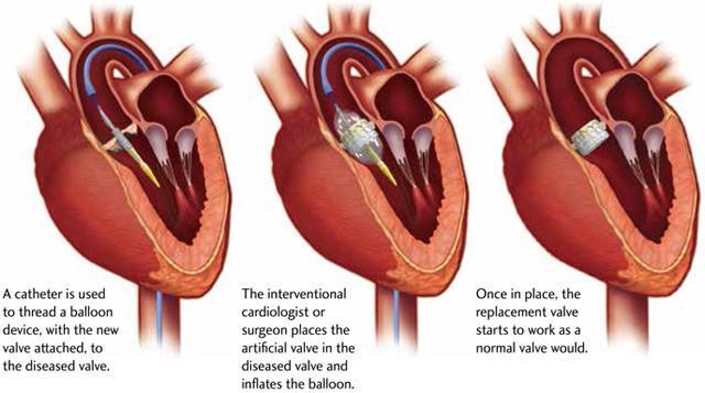 Transcatheter Aortic Valve Replacement (TAVR) During a TAVR procedure, a very small incision is made in the groin to access the femoral artery or the chest (transapical approach).