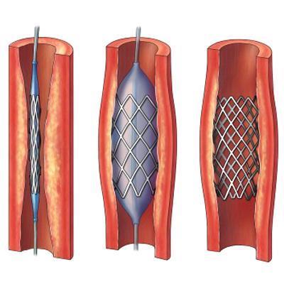 5. Atherosclerosis deposits of fatty materials such as cholesterol form a plaque