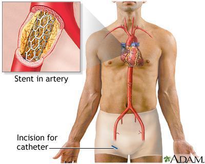 Treatment: Angioplasty, where a catheter is inserted into the artery and a