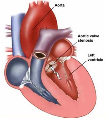 8. Aortic Stenosis - valve or aorta is narrowed, limiting blood flow. 9.
