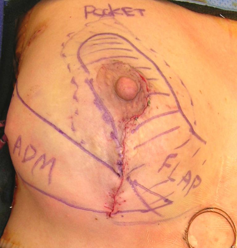 Gland Surgery, Vol 4, No 3 June 2015 259 Figure 1 58F after right breast biplanar oncoplasty technique with central/lateral lumpectomy of 40 g, circumvertical incision with utilization of medial