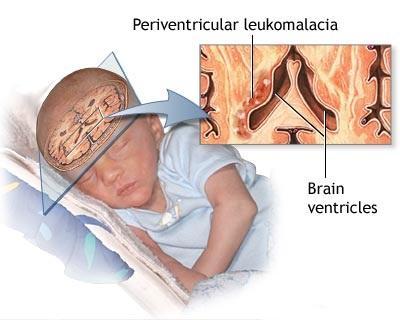Periventricular Leukomalacia Etiology: ischemic infarction of white matter adjacent to lateral ventricles Associated medical conditions include: Antenatal or Intrapartum