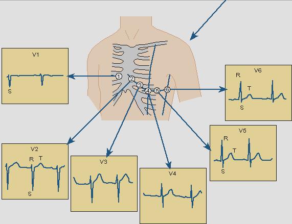 Figure 5-5 Sites of six unipolar chest leads (V1 V6). To determine sites of chest leads: From the angle of Louis, move your fingers to the right and you will feel a gap between the ribs.