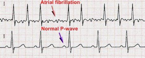 2-Rhythm : Heart rhythm can be either regular or irregular.this can be determined by looking again at the R-R wave interval.
