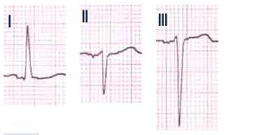 The direction of the axis can be derived more easily from QRS complex in lead I, lead II, and lead III.