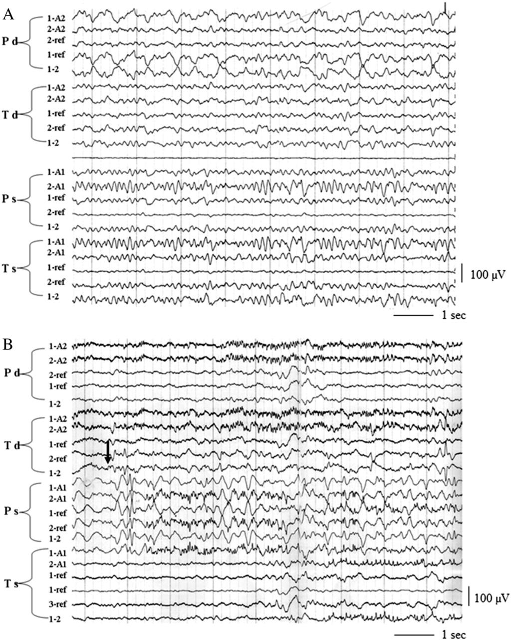 A.Y. Stepanenko et al. / Epilepsy & Behavior Case Reports 1 (2013) 45 49 47 Fig. 2. Neurophysiological findings (invasive recording).