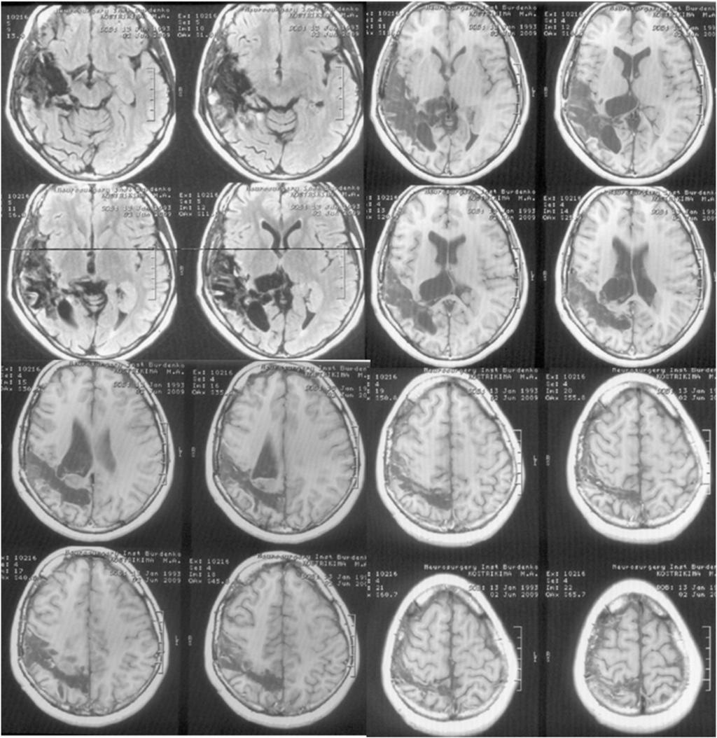 48 A.Y. Stepanenko et al. / Epilepsy & Behavior Case Reports 1 (2013) 45 49 Fig. 3. Postoperative MRI. Volume of surgical intervention (described in the text of the article).