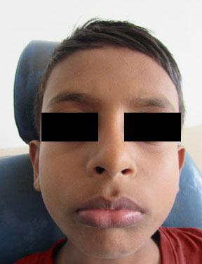 Figure 11: Post operative photograph DISCUSSION According to literature the best time for treatment with oral screen is 31/2 years to 4 years of age.