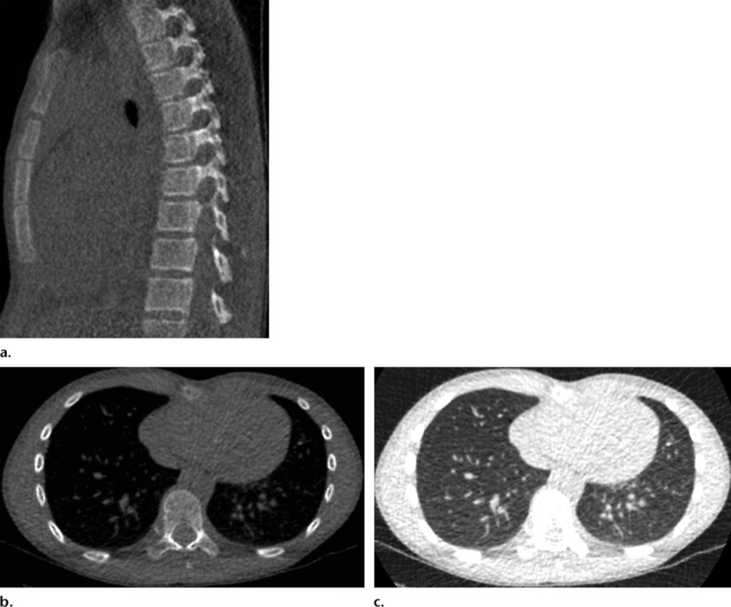 RG Volume 35 Number 6 Kalra et al 1719 Figure 8. (a, b) Images in a 13-year-old boy (weight, 45 kg) who underwent reduced-dose chest CT for evaluation of pectus excavatum deformity.