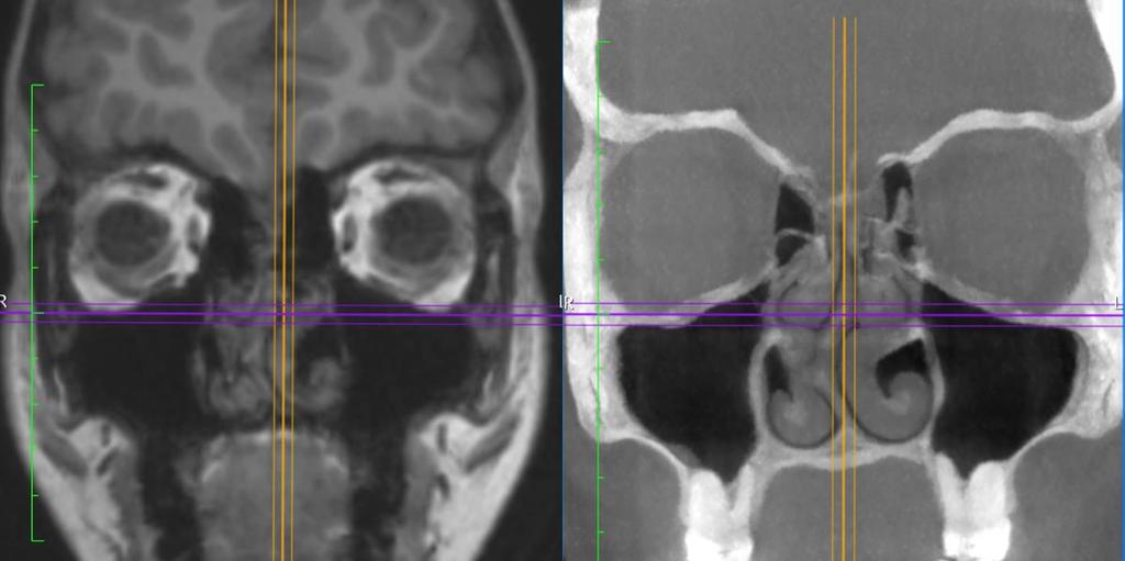 scans were constructed in DICOM format for comparison with CBCT DICOM volumes. Scans were reviewed for incidental pathology by a fellowship trained neuroradiologist.