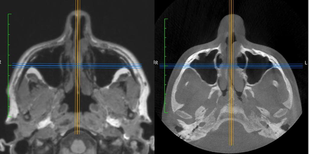 Figure 2. Orientation of the MR (left) and CBCT (right) DICOM volumes in the transverse plane.