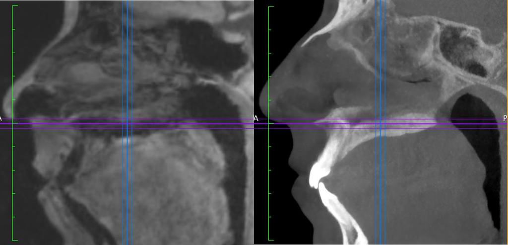 Orientation of the MR (left) and CBCT (right) DICOM volumes in the sagittal plane.