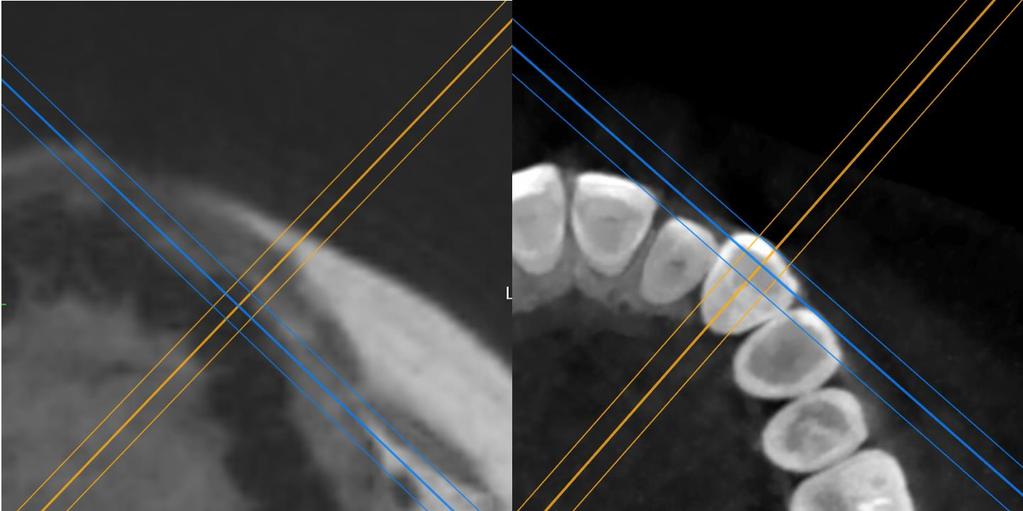 Slices were aligned along the long axis of incisors through the center of the incisal edge and root apex and perpendicular to a line through the center of