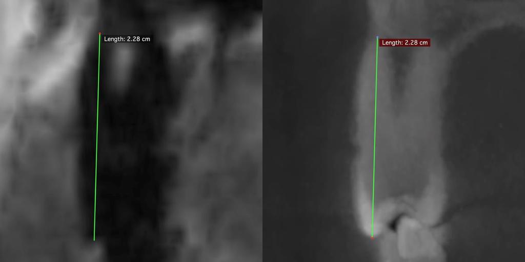 Figure 7. Measurement of a premolar. Shown here is a maxillary left first premolar on MR slice (left) and CBCT slice (right).
