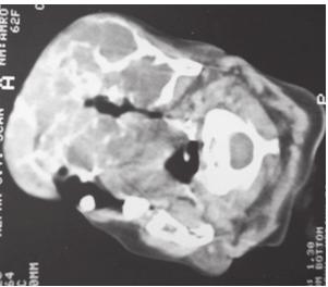 On retraction of the lips, a single irregular ulcerated swelling that obliterated the mandibular labial and lingual vestibule was seen (Figure 2).