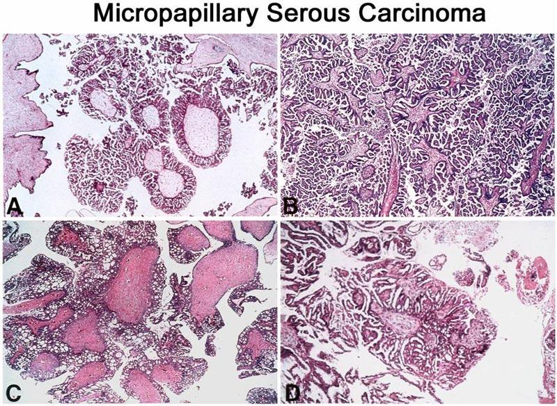 Noninvasive Micropapillary Serous Carcinoma