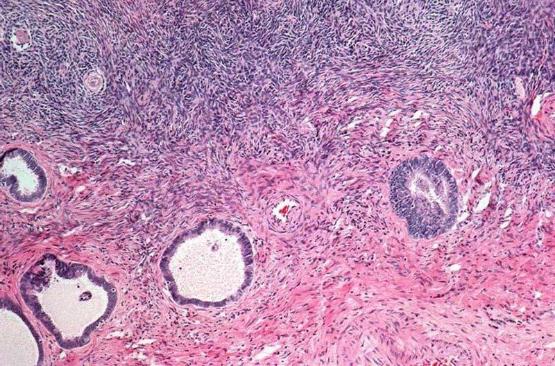 High-grade Serous Carcinoma Pathogenesis The precursors of