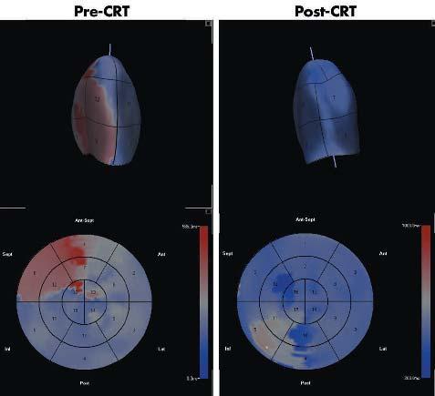 Figure 6 Parametri LV ast (top) and bulls eye display (bottom) in a patient pre- (left) and post- (right) ardia resynhronisation therapy (CRT).