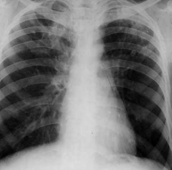Tuberculosis Dx may be