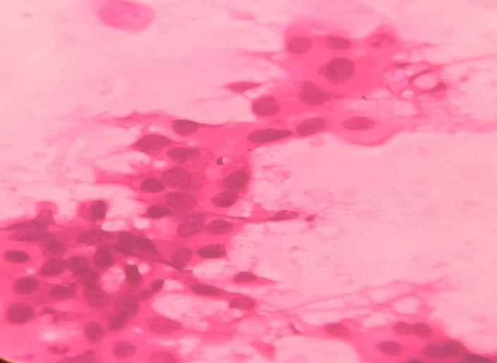 breast,40x:smear showing non cohesive clusters of