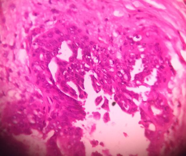 Fig 8: Fibrocystic disease:40x,section shows breast parenchyma enclosing a cystic lesion surrounded by proliferating mammary glands & cystically dilated ducts with some of the ducts showing