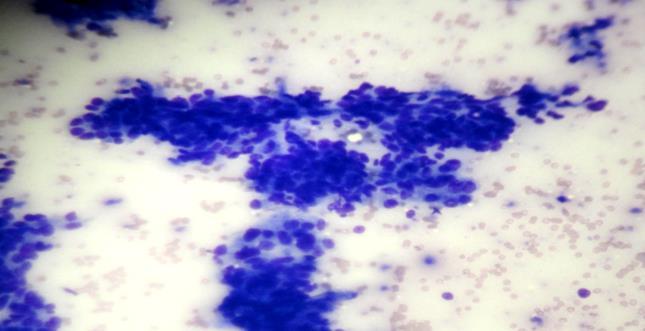 Figure 6: Microphotograph of FNA smears of carcinoma breast depicting pleomorphic tumor cells with prominent nucleoli and high N:C ratio (20x, MGG).