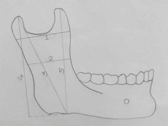 AIM AND OBJECTIVES 1) To evaluate various measurements of mandibular ramus on digital orthopantomographs. 2) To assess the usefulness of mandibular ramus in sex determination.